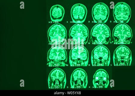 Irm du cerveau d'une personne en bonne santé sur un fond noir avec rétroéclairage vert. Place de gauche pour la publicité inscription Banque D'Images