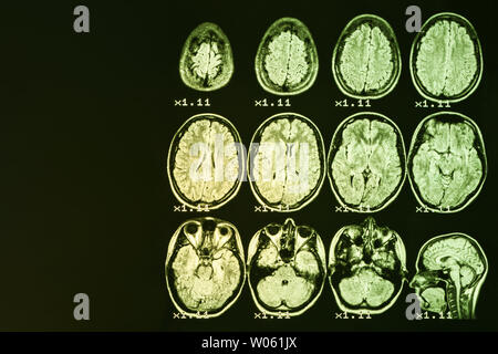 Irm du cerveau sur un fond noir avec rétro-éclairage jaune. Place de gauche pour la publicité inscription Banque D'Images