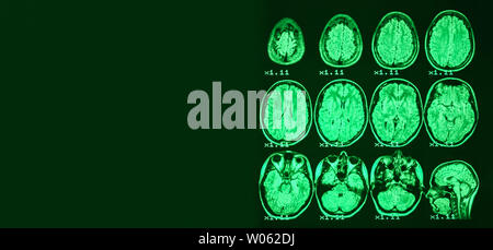 Bannière. Irm du cerveau d'une personne en bonne santé sur un fond noir avec rétroéclairage vert. Place de gauche pour la publicité inscription Banque D'Images