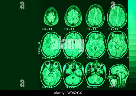 Irm du cerveau d'une personne en bonne santé sur un fond noir avec rétroéclairage vert. Place de gauche pour la publicité inscription Banque D'Images