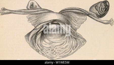 Image d'archive à partir de la page 761 de la cyclopaedia de l'anatomie et. La cyclopaedia de l'anatomie et physiologie cyclopdiaofana05todd Année : 1859 68fi l'utérus et ses appendices. moi dans un cas dont j'ai été témoin d'une femme âgée dont l'utérus est devenu complètement en- verted lors d'une convulsion. Dans ce cas, la seule cause prédisposant apparent était la Fig. 470. Inversion incomplète de l'utérus. (D'après J. G. Forbes.) le fundus commence à dépasser par l'os de l'utérus, glisser après il les trompes de Fallope, qui sont tirés dans le creux formé par les organes inversés. dilatation de l'utérus ca Banque D'Images