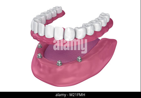 Pour Prothèse hybride être assis sur implants - ball pièces jointes. 3D illustration Banque D'Images