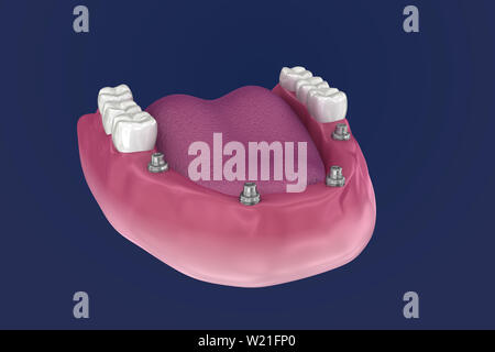 Pour Prothèse hybride être assis sur 4 implants - ball pièces jointes. 3D illustration Banque D'Images