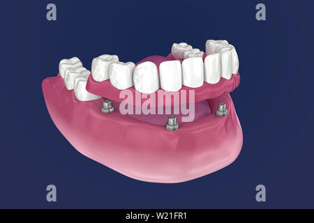 Pour Prothèse hybride être assis sur 4 implants - ball pièces jointes. 3D illustration Banque D'Images