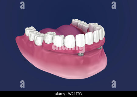 Pour Prothèse hybride être assis sur 4 implants - ball pièces jointes. 3D illustration Banque D'Images