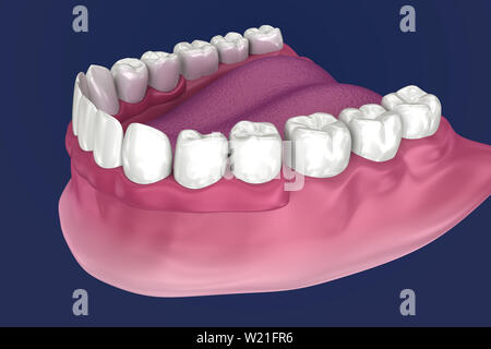 Pour Prothèse hybride être assis sur 4 implants - ball pièces jointes. 3D illustration Banque D'Images