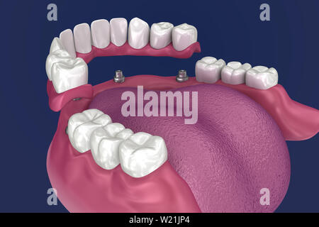 Pour Prothèse hybride être assis sur 4 implants - ball pièces jointes. 3D illustration Banque D'Images