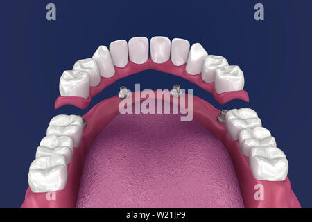 Pour Prothèse hybride être assis sur 4 implants - ball pièces jointes. 3D illustration Banque D'Images