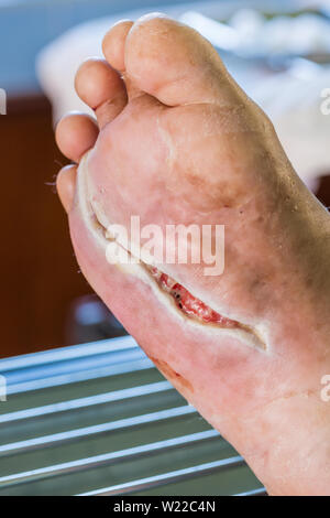 Plaies infectées du pied diabète Banque D'Images