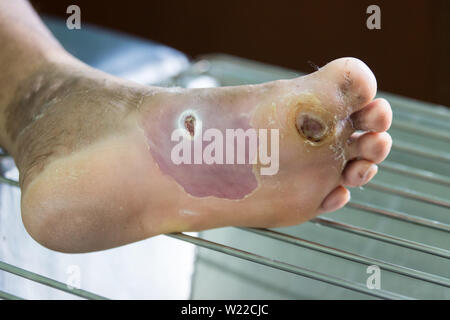 Plaies infectées du pied diabète Banque D'Images