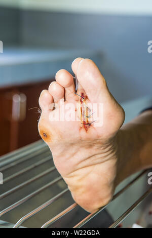 Plaies infectées du pied du diabète Banque D'Images