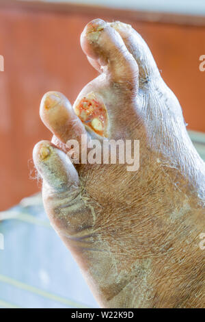 Plaies infectées du pied du diabète Banque D'Images