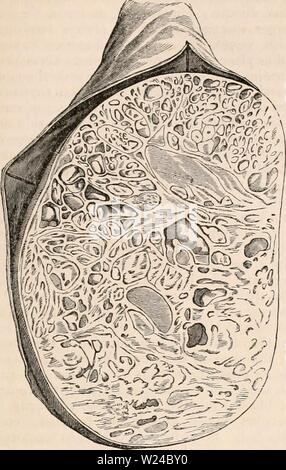 Image d'archive à partir de la page 226 de la cyclopaedia de l'anatomie et. La cyclopaedia de l'anatomie et physiologie0402cyclopdiaofana todd Année : 1849 (TESTICULE ANATOMIE anormale). développé sous deux formes. Dans l'un, il se produit en association avec careinomatous- : Fig. 654. Section d'une tumeur kystique du testicule, montrant une multitude de kystes de diverses formes et tailles, avec la matière solide interposé entre eux. La structure glandulaire est icholly détruit. dans l'autre et forme plus courante, la tumeur est d'un caractère innocent, et exempts de la maladie risque de s'attaquer à d'autres parties d'une Banque D'Images