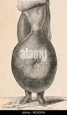 Image d'archive à partir de la page 229 de la cyclopaedia de l'anatomie et. La cyclopaedia de l'anatomie et physiologie0402cyclopdiaofana todd Année : 1849 10 J4 cumference, et presque d'atteindre le sol lorsque le patient est en position verticale. Dans un cas opéré par Clot Bey en Egypte, la masse morbide, qui pesait cent dix livres, tenu les jambes du patient très éloignées, et l'oblige à rester constamment sur le terrain ; c'était tellement gros qu'il pouvait même s'asseoir sur elle. Dans la figure Fig. 656. Testicule (anatomie anormale). d'un homme noir, affecté à l'éléphantiasis, prises à partir de la dr Banque D'Images