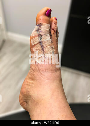 Jour 10 Après l'oignon et la chirurgie de hammertoe, juste avant les points de suture ont été supprimés. Banque D'Images