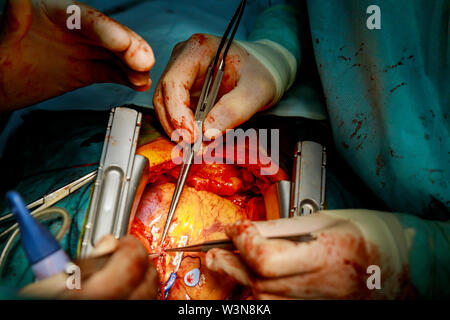 Chirurgiens travaillant avec des ciseaux sur un patient à un chirurgien cardiaque ouvrir d'opération Banque D'Images