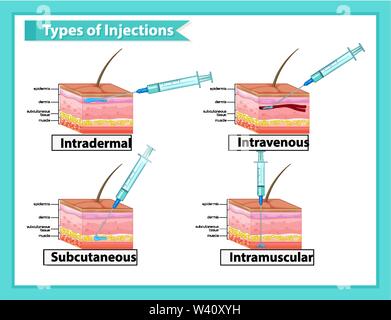 Illustration médicale scientifique de types d'injections illustration Illustration de Vecteur