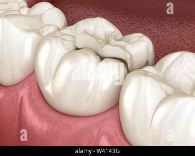 La fixation de la couronne en céramique encastré à plus de dent. Illustration 3D précis sur le plan médical de traitement des dents humaines Banque D'Images