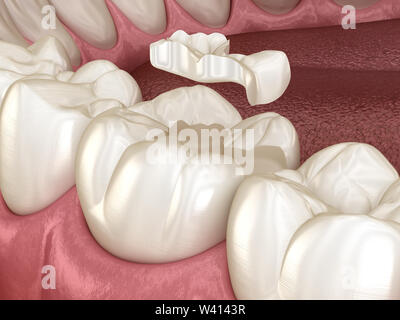 La fixation de la couronne en céramique encastré à plus de dent. Illustration 3D précis sur le plan médical de traitement des dents humaines Banque D'Images