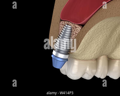 La chirurgie d'ascenseur de sinus - installation de l'implant. 3D illustration Banque D'Images