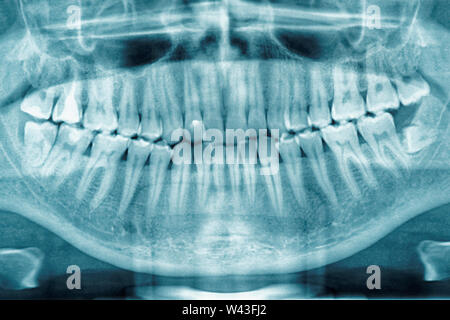 La radiographie dentaire panoramique entièrement, dent de sagesse est vu Banque D'Images