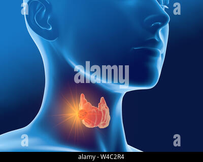 3D illustration médicale cancer de la thyroïde d'une femme, médicalement illustration sur fond bleu Banque D'Images