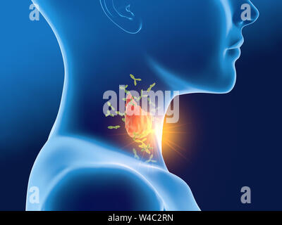 3D illustration médicale montrant l'attaque d'anticorps thyroïde d'une femme. Banque D'Images