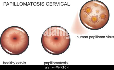 Vector illustration de la papillomatose du col du virus du papillome humain. Illustration de Vecteur