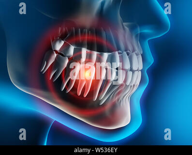 La douleur dentaire lourd - 3D illustration Banque D'Images
