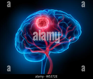 Avec les vaisseaux sanguins du cerveau et la tumeur- 3d illustration Banque D'Images