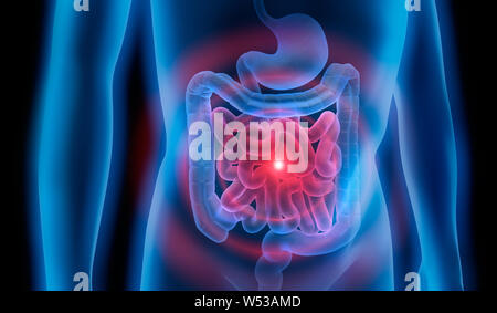 L'infection intestinale estomac intestin - Maladie - 3D illustration Banque D'Images