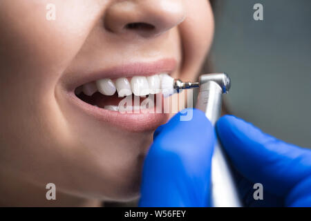 Processus d'utilisation de brosse stomatologiques comme une étape de la procédure de nettoyage dentaire professionnel en clinique, Close up Banque D'Images