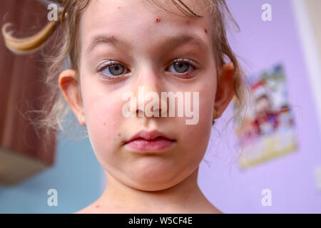 Portrait d'enfant triste fille avec des virus a la varicelle, la rougeole, la varicelle, la rubéole sur tout le corps. Maladies virales Banque D'Images