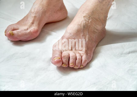 Libre d'un pied à l'aide d'ongles endommagés à cause de champignon. Femme âgée jambes Banque D'Images