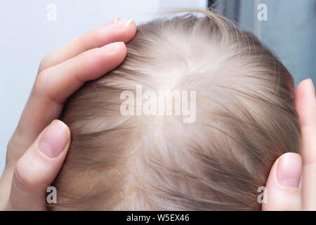 La maladie fongique de la peau dermatite séborrhéique dans une tête de l'enfant, close-up, séborrhée crust Banque D'Images