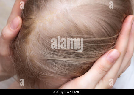 La maladie fongique de la peau dermatite séborrhéique dans une tête de l'enfant, close-up, séborrhée crust Banque D'Images