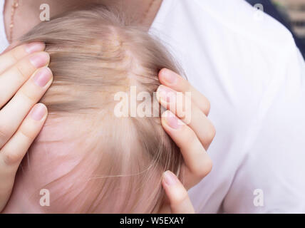 La maladie fongique de la peau dermatite séborrhéique dans une tête de l'enfant, close-up, séborrhée crust Banque D'Images