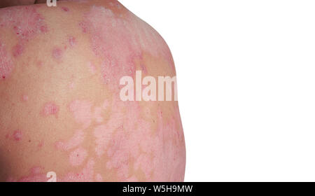 Close up flakes à l'arrière. Maladies causées par des anomalies de la lymphe. Le psoriasis est une maladie de la peau. Banque D'Images