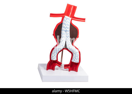 Le traitement endovasculaire des anévrismes de modèle avec endoprothèse fenêtrée et ramifiées-greffes. Banque D'Images