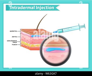 Illustration médicale scientifique de l'injection intradermique - illustration Illustration de Vecteur