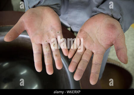 Un travailleur chinois montre ses mains après avoir rôti Mingqian thé Longjing bouilloire avec thé pots friture d'une usine à Hangzhou, ville de la Chine est Zhejia Banque D'Images
