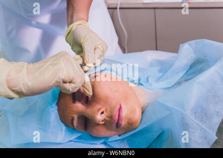 Faire mesothreads femme d'âge et de levage, la cosmétologie. Chirurgie esthétique pour éliminer les signes de vieillissement. Beauté Visage, contour du visage, plastique Banque D'Images