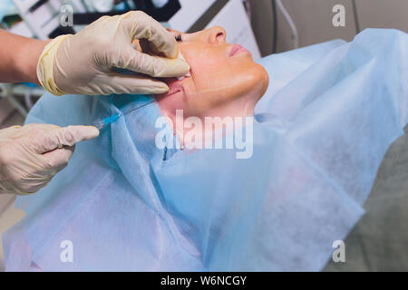 Faire mesothreads femme d'âge et de levage, la cosmétologie. Chirurgie esthétique pour éliminer les signes de vieillissement. Beauté Visage, contour du visage, plastique Banque D'Images