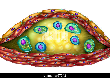 Structure de plaque athérosclérotique, illustration de l'ordinateur. Le centre nécrotique, mousse T-lymphocytes et cellules sont visibles à l'intérieur de la plaque de cholestérol. Les murs sont faits de cellules musculaires lisses et de l'endothélium des vaisseaux sanguins. Banque D'Images