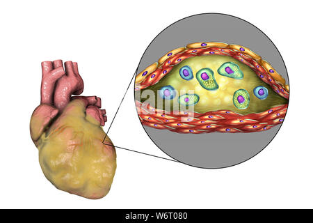 Les maladies du cœur, l'illustration de l'ordinateur. Gras et malades du coeur de section d'une plaque d'athérome et sa structure histologique, tels que centre nécrotique, cellules de mousse et T-lymphocytes. Ses murs sont faits de cellules musculaires lisses et de l'endothélium des vaisseaux sanguins. Banque D'Images