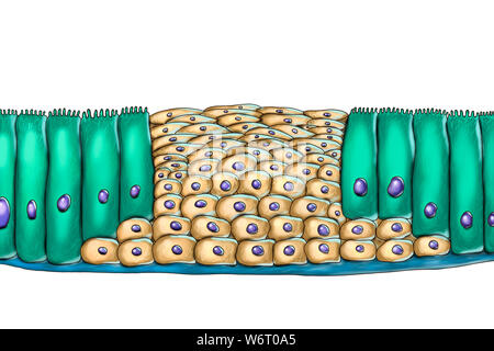 La métaplasie épithéliale, illustration de l'ordinateur. La métaplasie est un changement de type de cellule dans une région. Cette illustration montre de métaplasie squameuse de l'épithélium respiratoire, une conséquence de la cigarette. Banque D'Images