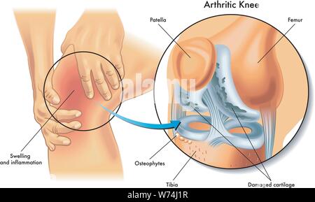 Illustration médicale des symptômes de l'arthrite du genou Illustration de Vecteur