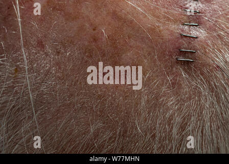 Voir de 65 ans homme's cuir chevelu de carcinome site (horizontal) au centre le long des cheveux. Site est environ 3/4'', 1/4 dans l'ensemble élevé. Banque D'Images
