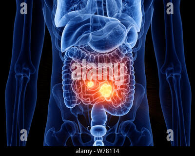 Médicalement en rendu 3d illustration de l'exacte du cancer de l'intestin grêle Banque D'Images