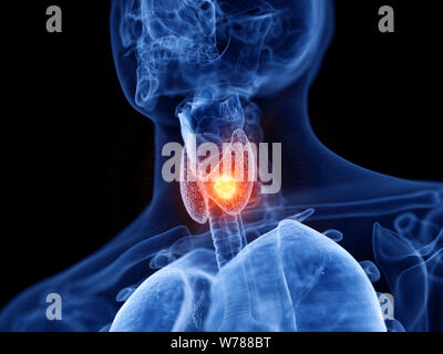 Médicalement en rendu 3d illustration exacte du cancer de la thyroïde Banque D'Images